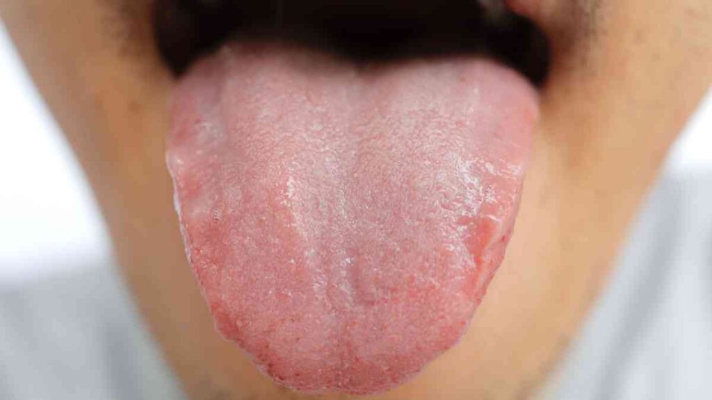 Língua branca pode indicar acúmulo de resíduos e problemas de saúde bucal