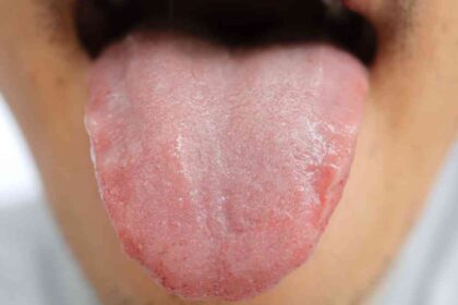 Língua branca pode indicar acúmulo de resíduos e problemas de saúde bucal