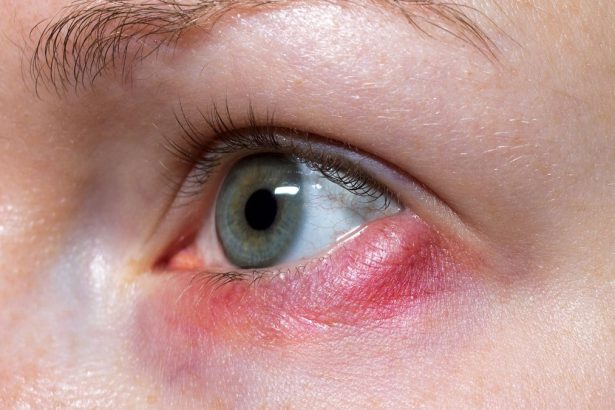 Pessoa com desconforto ocular causado por terçol durante período de clima seco
