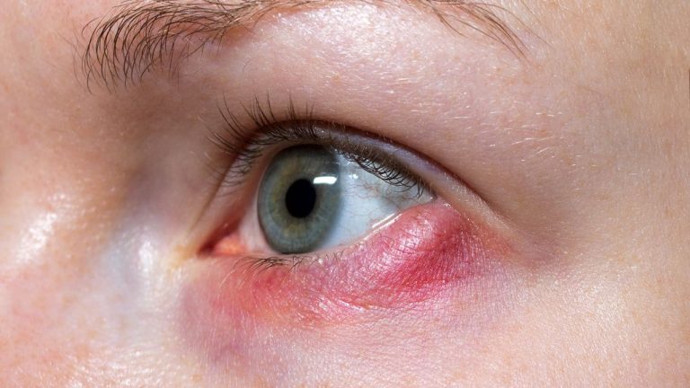 Pessoa com desconforto ocular causado por terçol durante período de clima seco
